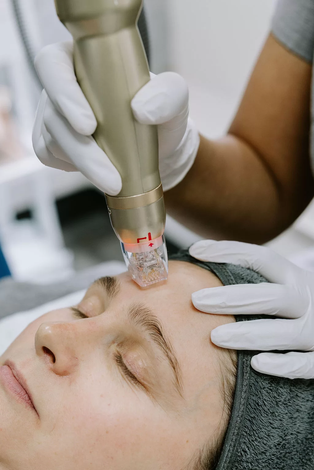 SylfirmX RF microneedling treatment in progress